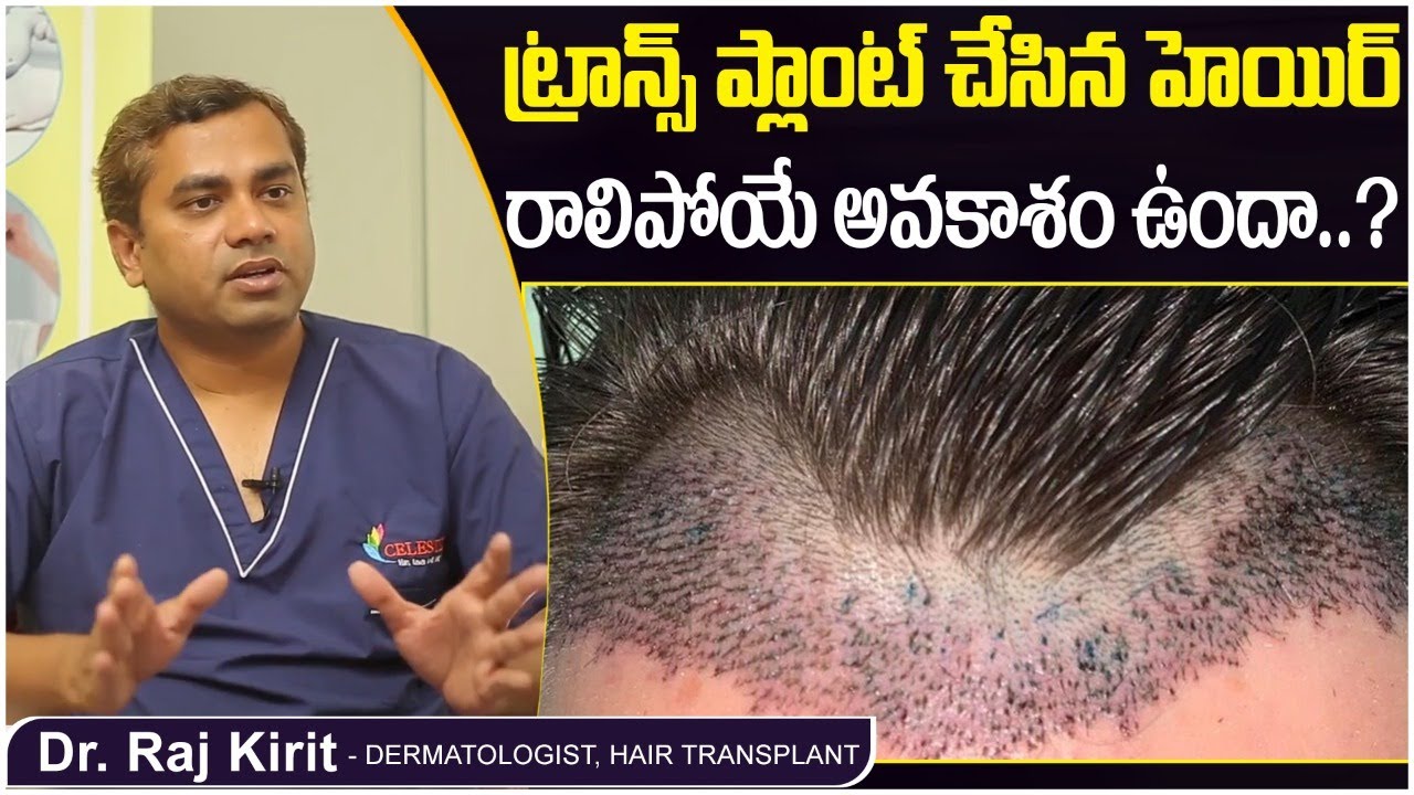 ట్రాన్స్ ప్లాంట్ చేసిన హెయిర్ రాలిపోతాదా? | Hair Fall After Hair Transplant Telugu | Celestee Clinic