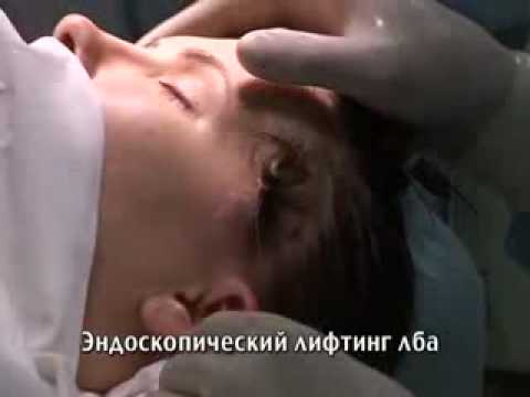Эндоскопический лифтинг лба, хирург Валерий Якимец