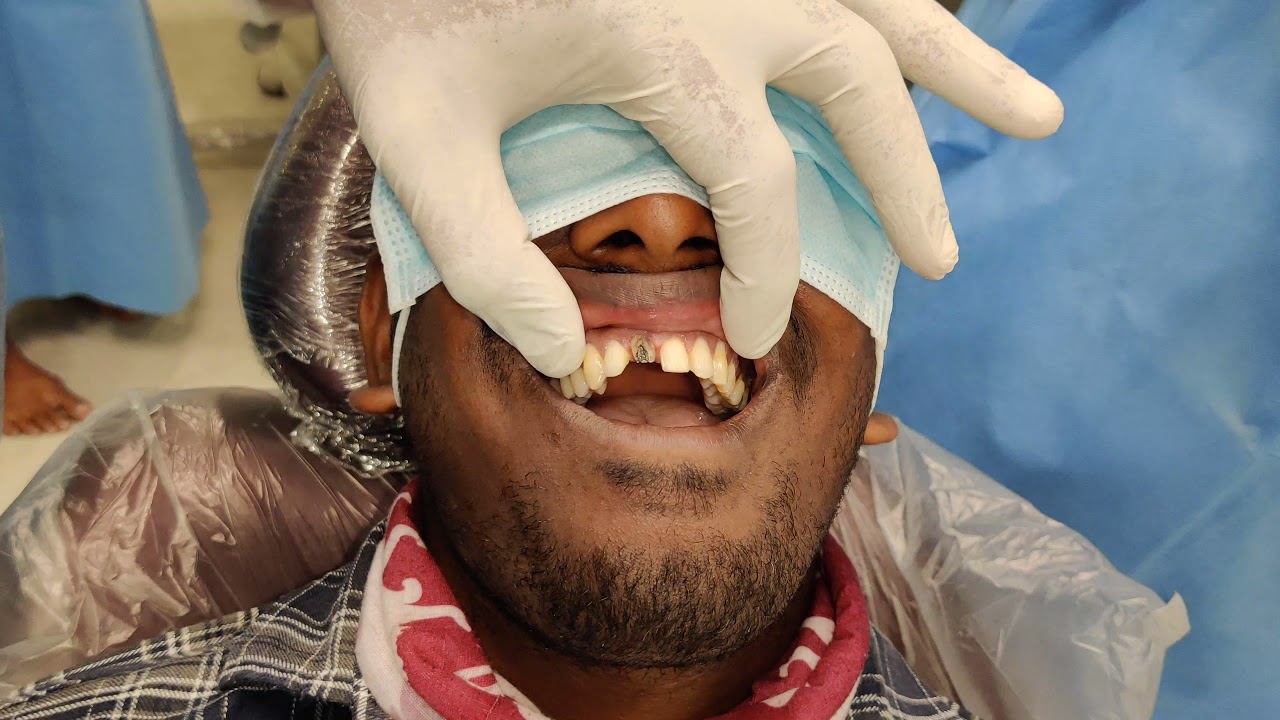 அழகான தத்ரூபமான முன் பல் கட்டப்படும் முறை Front teeth replacement by veneer / zirconia crown