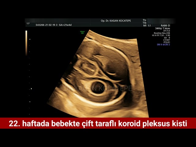 Koroid pleksus kist, iki taraflı, ultrason görüntüsü. KPK fetusta sorun anlamına mı gelir, geçer mi?
