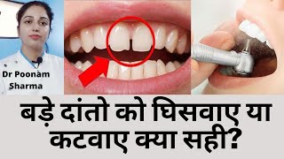 बड दत क घसवए य कटवए कय सह ह?Cut Front Big Teethbade Danto Ko Ghishwana Ya Katwana