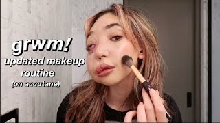 my everyday makeup routine 2023 with acne (while on accutane)