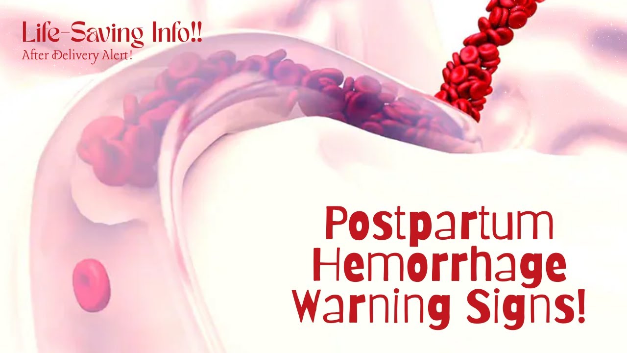 Heavy Bleeding After Delivery? Postpartum Hemorrhage Explained! - YouTube