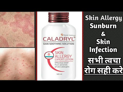 Caladryl Skin Soothing Lotion Review || Skin allergy infection itching & Sunburn medicine