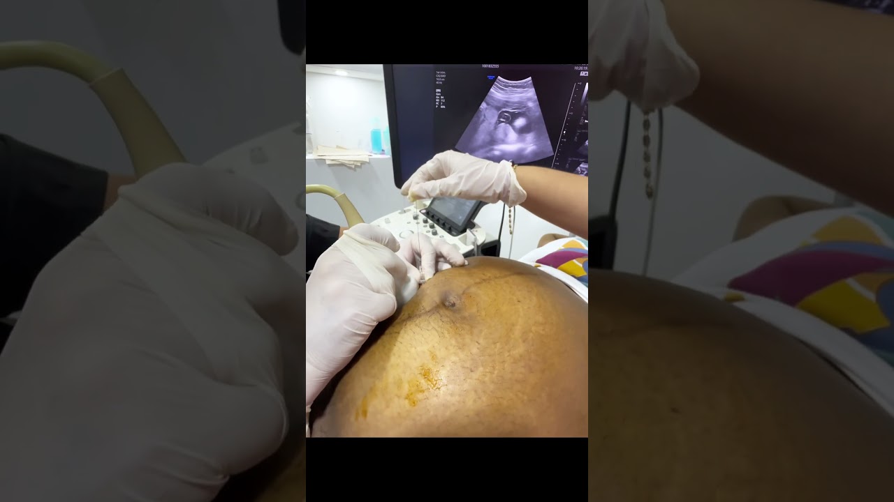 CORDOCENTESIS. #unifetal #cordocentesis #embarazo #perinatologia #cartagena #barranquilla #santa