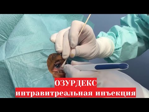 Укол 💉 Озуредекса в глаз 👀 (интравитреальное введение) - видео процедуры