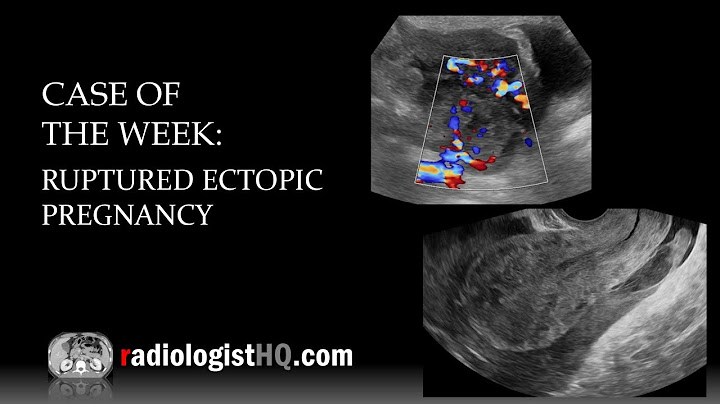 What does an ectopic pregnancy look like on ultrasound