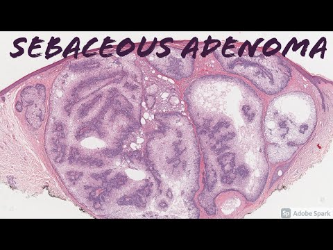 ಸೆಬಾಸಿಯಸ್ ಅಡೆನೊಮಾ: 5-ನಿಮಿಷದ ರೋಗಶಾಸ್ತ್ರದ ಮುತ್ತುಗಳು