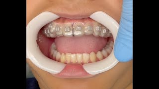 Indirect Bonding: Preparation and Bonding Sequence
