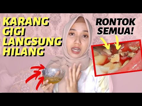 Jangan Merontokkan Karang Gigi Dirumah Sebelum Tonton Video Ini // #NgomonginGigiPakeBukti