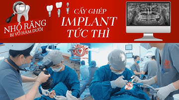 Chi Tiết Các Bước Cấy Ghép Implant Răng Hàm Dưới Diễn Ra Như Thế Nào?| Nha khoa Đặng Xá - S-Dental