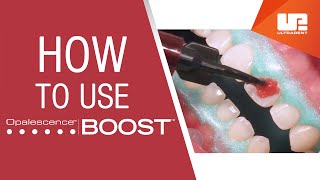 How to Use Opalescence™ Boost™ Professional Teeth Whitening | StepbyStep Procedure