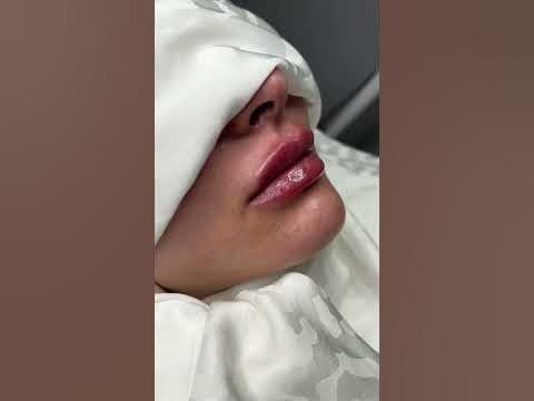 Губы 1 мл , после - YouTube