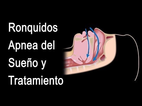 Ronquidos, Apnea Obstructiva del Sueño y Tratamiento, Animación. Alila Medical Media Español.