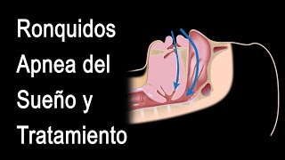 Ronquidos, Apnea Obstructiva del Sueño y Tratamiento, Animación. Alila Medical Media Español.