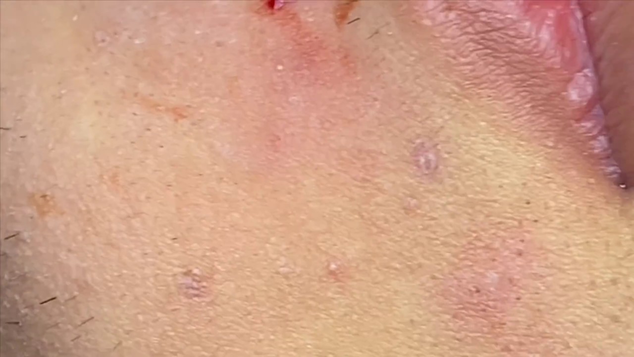 Treating Acne On Sunburned Skin | Điều Trị Mụn Trên Da Cháy Nắng - SacDepSpa#85