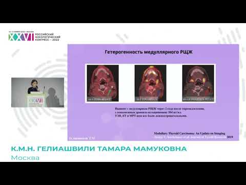 Радиоизотопная диагностика и лечение медуллярного рака щитовидной железы