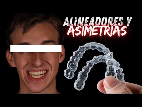 ¿Se puede CORREGIR la ASIMETRÍA con ALINEADORES INVISIBLES?