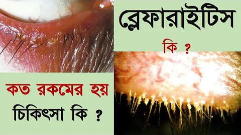 What is Blepharitis: its symptoms, signs, and trea...
