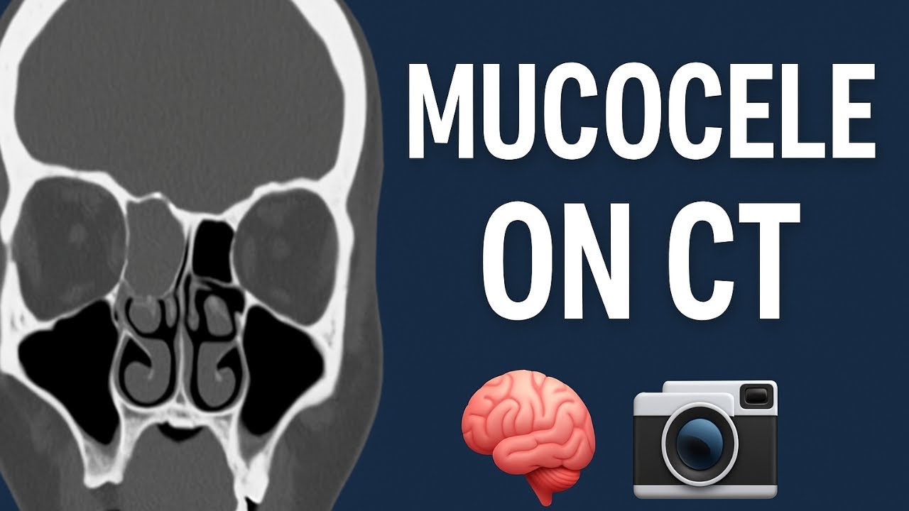 Фронтальная мукоцеле на КТ: 3 ключевых признака, которые нужно знать 🧠📸