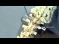 Pedicle Screw Fixation- CORE Spinal System