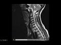 Anatomía RM Cervical