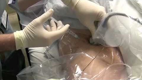 Ultrasound-guided Continuous Femoral Nerve Block