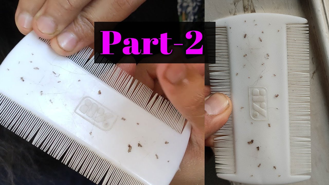 Lices Nits Picking Killing Hair Head Full of Lices Part2 ASMR Pakistan