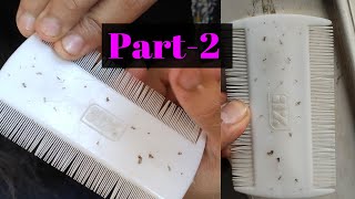Lices Nits Picking Killing Hair Head Full of Lices Part-2 ASMR Pakistan
