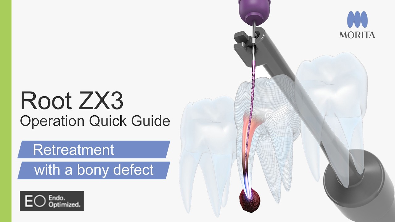 Root ZX3 Operation Quick Guide - Retreatment with a bony defect