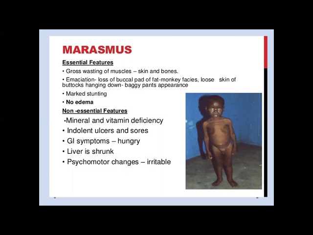 Pathophysiology of MalnutritionMarasmus VS Kwashiorkor