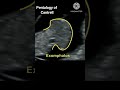 Normal,abnormal fetal heart at 11-13 weeks on ultrasound 