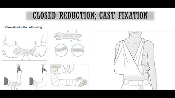 Closed Reduction Technique and Cast Application in Pediatric Forearm Fractures.