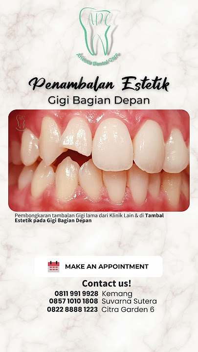 Penambalan Estetik pada Gigi Depan. Yess Looks Gorgeous On You !