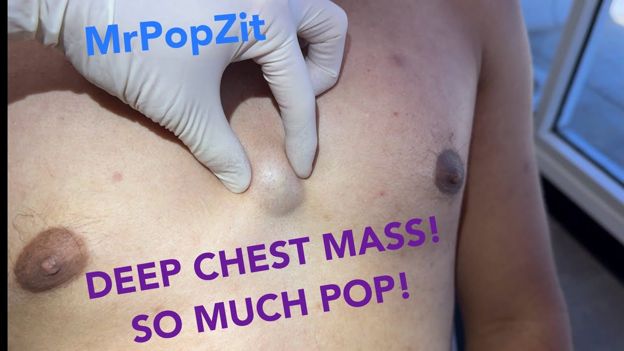 Popped Chest MrPopZit aka Greg Lynch Derm PA | PreserveTube