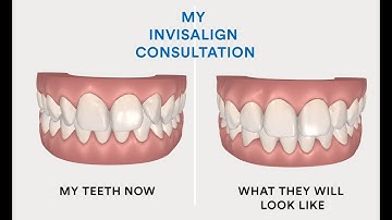 MY INVISALIGN JOURNEY #1 ▸ Consultation