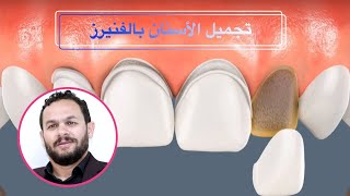فينير الأسنان المزايا والعيوب وطريقة التركيب