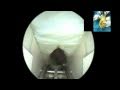 Canal carpien endoscopique endoscopic carpal tunnel release agee technique