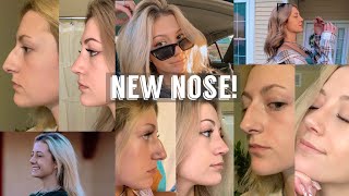 Rhinoplasty Cast Removal & NEW NOSE REVEAL