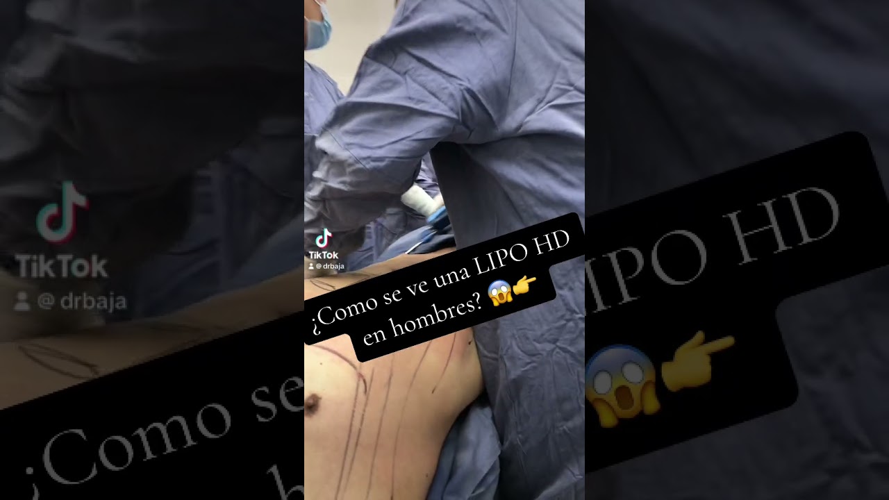 Lipo HD en Hombres 😱✨ 