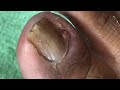 Ep_6084  Ingrown toenail removal 👣 กลัวหรือ..เสียวมากกว่าครับ  😊 (clip from Thailand)