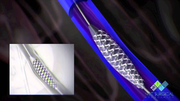 Animation of Venogram, Angioplasty, Stent, IVUS, Vena Cava Filter