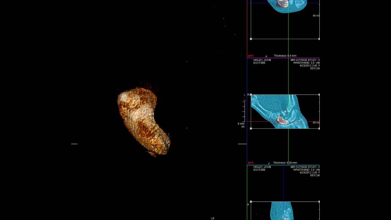 How to make scaphoid 3D images