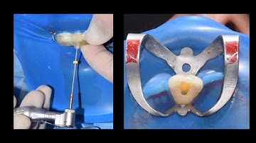 Guided endodontic access for root canal treatment for calcified Maxillary Central Incisor