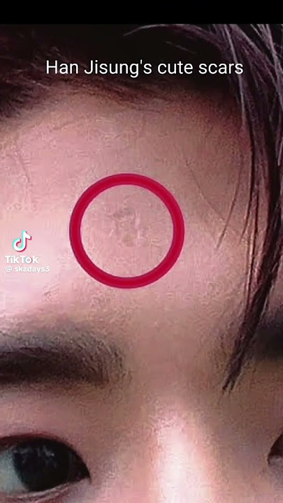 his scars are so cute 🥰💖🐿️ #kpop #straykids #hanjisung #notmyvid #nohate