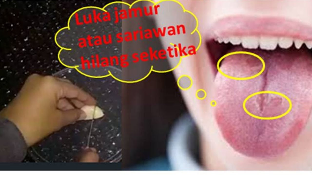 how to get rid of canker sores || Cara menghilangkan luka dan sariawan