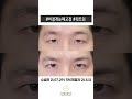 [Before&amp;After] 비절개눈매교정 윗트임 l 르미엘성형외과