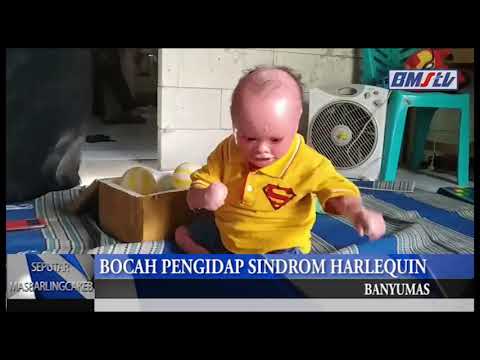 BOCAH PENGIDAP SINDROM HARLEQUIN