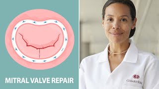 Mitral Valve Repair: Different Approaches for Different Patients (Interview with Dr. Joanna Chikwe)