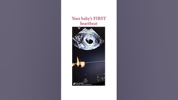 Your Baby’s FIRST Heartbeat on Ultrasound!💓 #drbhumikabansal #heartbeat #pregnancy #trending #short